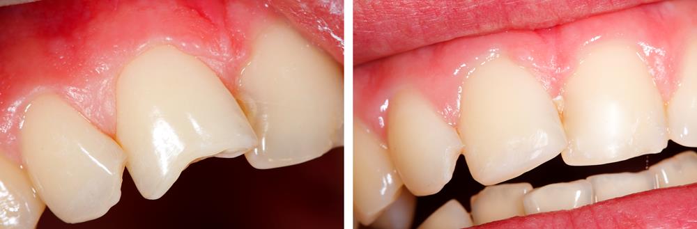 cracked tooth treatment in  Bellevue, WA 